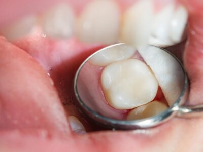 liječenje zuba zubnim ispunama